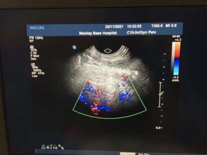 Philips C10-3v Ultrasound Transducer Probe for iU22