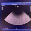 Philips S5-1 Broadband Sector Array Ultrasound Transducer Probe – IU22 – Defects