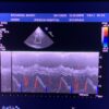 Philips S12-4 Sector Array Ultrasound Transducer Probe