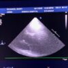 Philips S12-4 Sector Array Ultrasound Transducer Probe