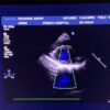 Philips S5-1 Broadband Sector Array Ultrasound Transducer Probe