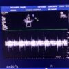 Philips S5-1 Broadband Sector Array Ultrasound Transducer Probe