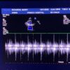 Philips S5-1 Broadband Sector Array Ultrasound Transducer Probe