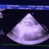 Philips S5-1 Broadband Sector Array Ultrasound Transducer Probe