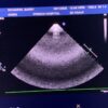 Philips S5-1 Broadband Sector Array Ultrasound Transducer Probe