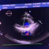 Philips X5-1 xMATRIX Array Ultrasound Transducer Probe w PureWave Crystal Technology