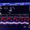 Philips X5-1 xMATRIX Array Ultrasound Transducer Probe w PureWave Crystal Technology