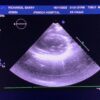 Philips X5-1 xMATRIX Array Ultrasound Transducer Probe w PureWave Crystal Technology