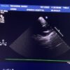 Philips S8-3 Sector Array Ultrasound Transducer Probe