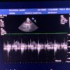 Philips S8-3 Sector Array Ultrasound Transducer Probe