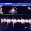 Philips S8-3 Sector Array Ultrasound Transducer Probe