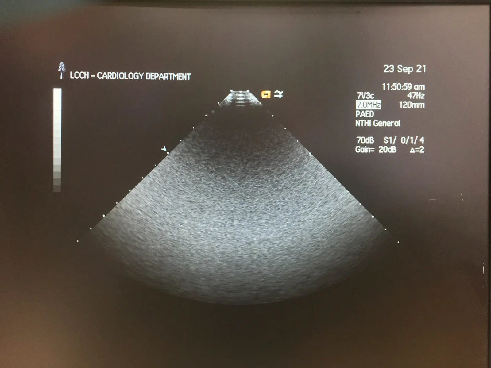 Siemens 7V3c Acuson Ultrasound Probe Transducer