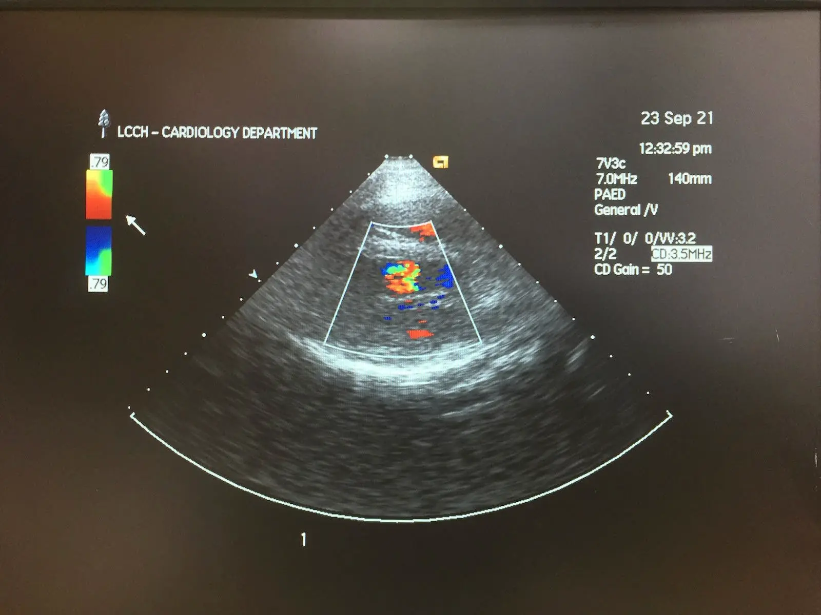 Siemens 7V3c Acuson Ultrasound Probe Transducer