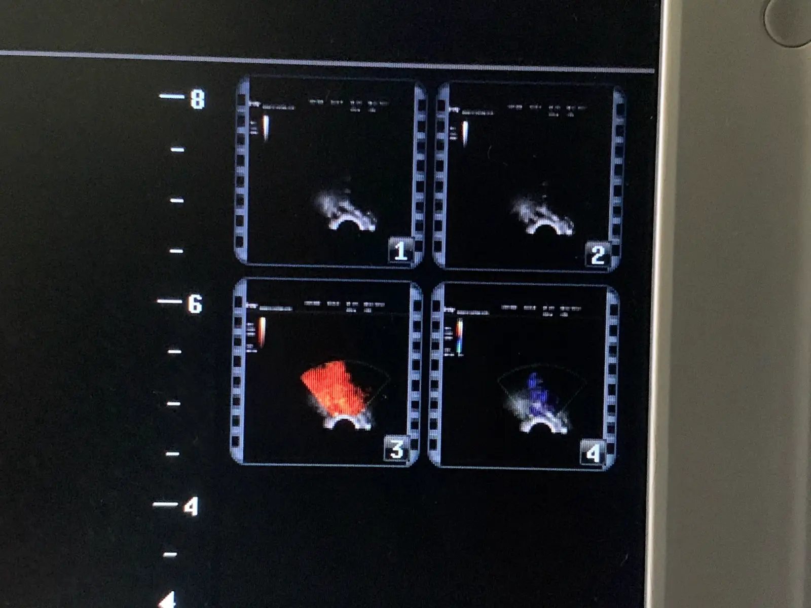 Mindray V10-4s Micro-Convex Endocavity Transducer Probe for M7 M6 Series
